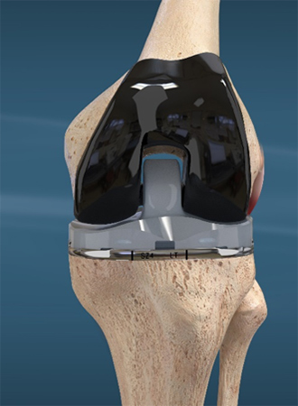 Journey II Basic Knee