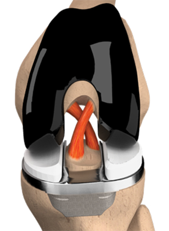 XR ACL Retaining